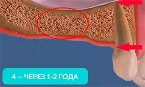 Через 1-2 года